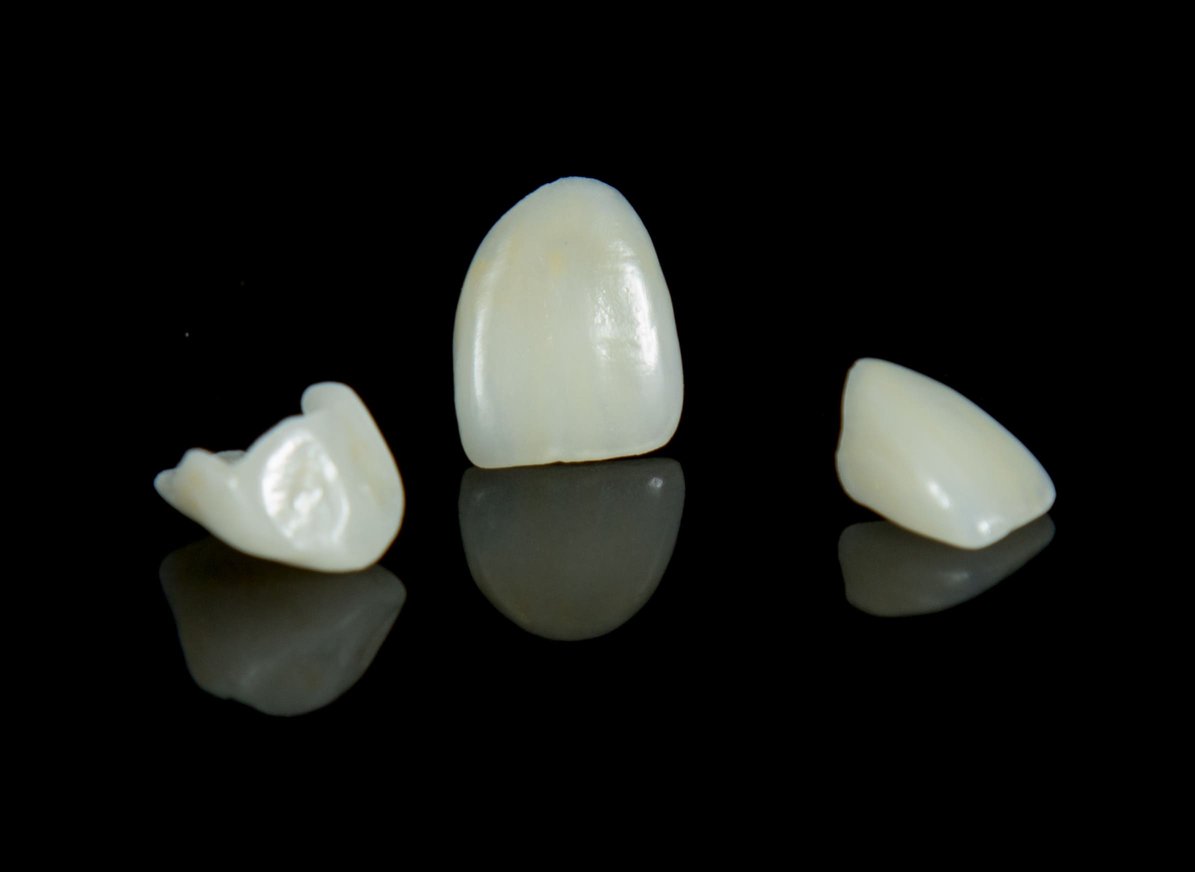 IPS e.max Press Veneers